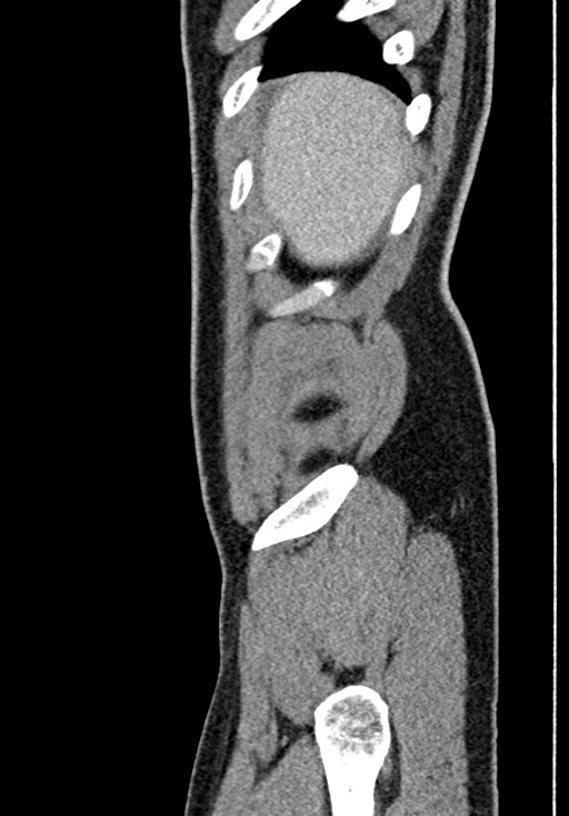 Adhesional small bowel obstruction (Radiopaedia 58900-66131 Sagittal C+ portal venous phase 23).jpg