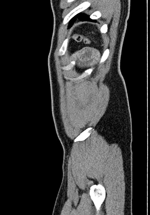 Adhesional small bowel obstruction (Radiopaedia 58900-66131 Sagittal C+ portal venous phase 233).jpg