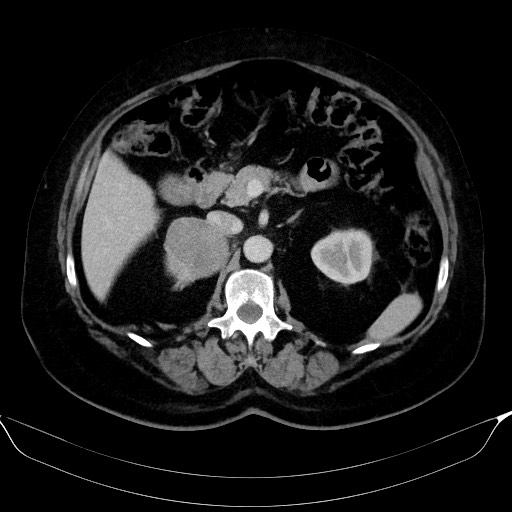 File:Adrenal cortical carcinoma (Radiopaedia 64017-72769 Axial C+ portal venous phase 24).jpg