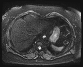 Adrenal cortical carcinoma (Radiopaedia 64017-72770 Axial DWI 1).jpg