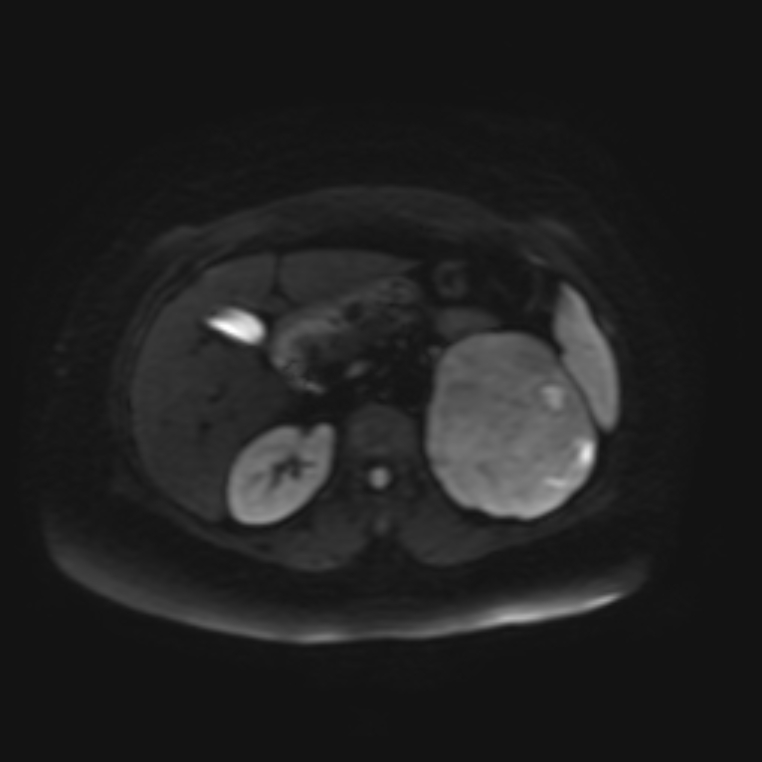 Adrenal cortical carcinoma (Radiopaedia 70906-81116 Axial DWI 11).jpg