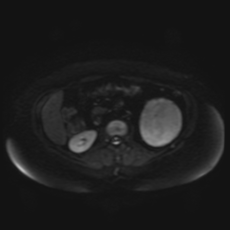 Adrenal cortical carcinoma (Radiopaedia 70906-81116 Axial DWI 17).jpg