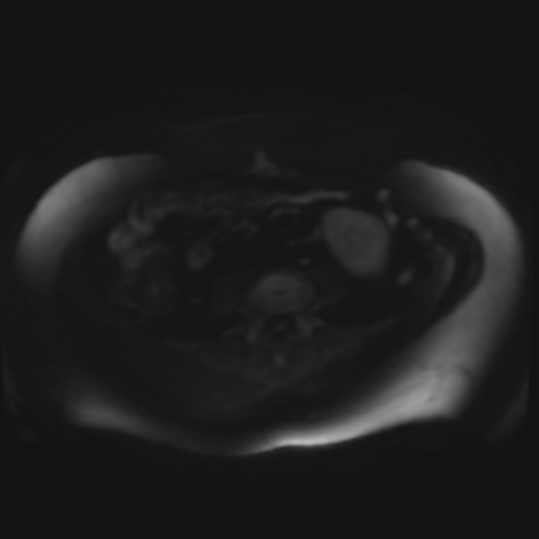 Adrenal cortical carcinoma (Radiopaedia 70906-81116 Axial DWI 54).jpg