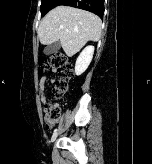 Adrenal cortical carcinoma (Radiopaedia 84882-100379 Sagittal C+ portal venous phase 24).jpg