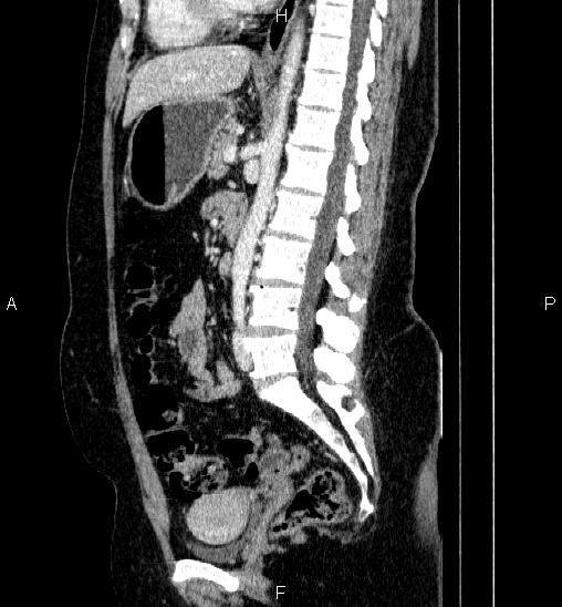 File:Adrenal cortical carcinoma (Radiopaedia 84882-100379 Sagittal C+ portal venous phase 48).jpg