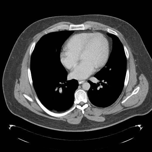 File:Adrenal cyst (Radiopaedia 45625-49776 Axial C+ portal venous phase 3).png