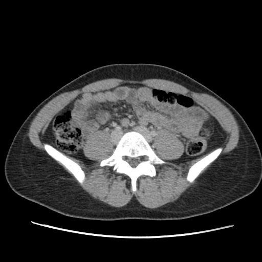 Adrenal cyst (Radiopaedia 64869-73813 Axial C+ portal venous phase 49).jpg
