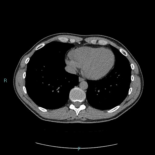 File:Adrenal cystic lymphangioma (Radiopaedia 83161-97534 Axial non-contrast 7).jpg