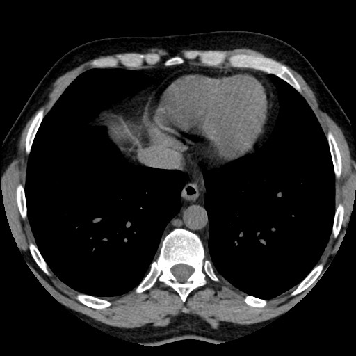 Adrenal gland trauma (Radiopaedia 81351-95079 Axial non-contrast 5).jpg