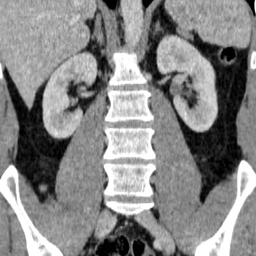 File:Adrenal glands (normal CT anatomy) (Radiopaedia 16570-105725 Coronal 9).jpg