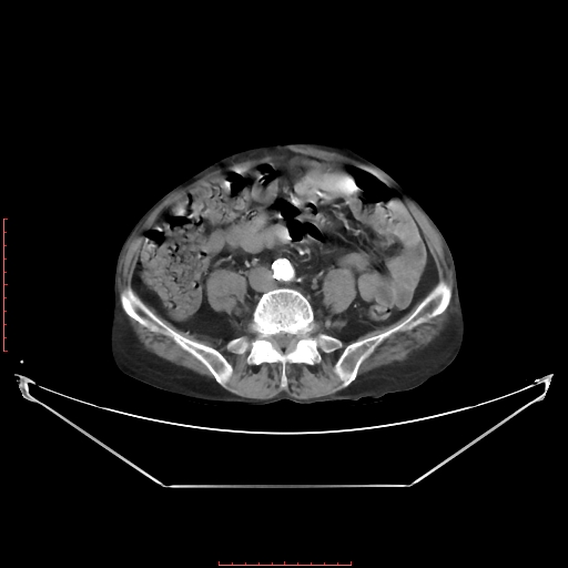 Adrenal hemangioma (Radiopaedia 68923-78668 Axial C+ arterial phase 49).jpg
