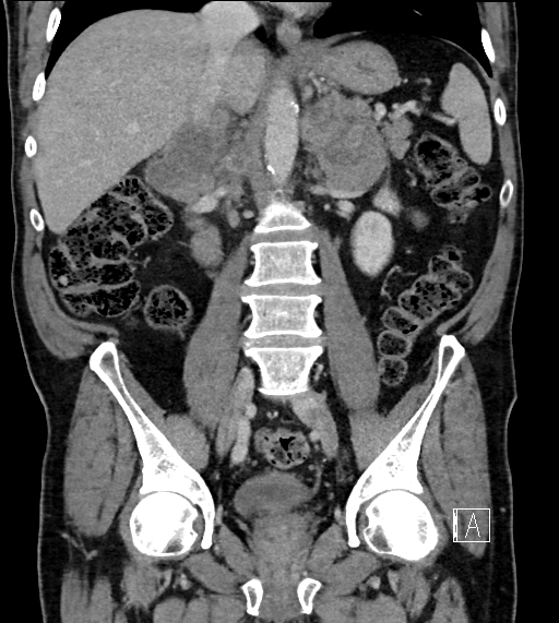 Adrenal lymphoma (Radiopaedia 73730-84529 Coronal C+ portal venous phase 45).jpg