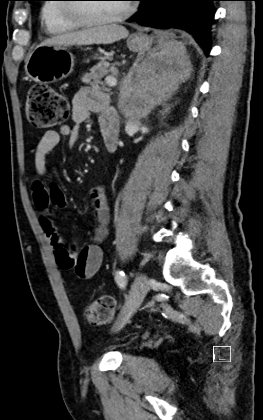 Adrenal lymphoma (Radiopaedia 73730-84529 Sagittal C+ portal venous phase 70).jpg