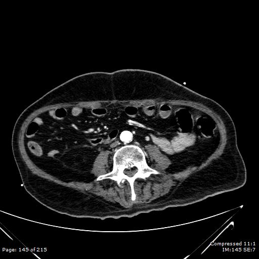 File:Adrenal metastasis (Radiopaedia 78425-91079 Axial C+ arterial phase 75).jpg