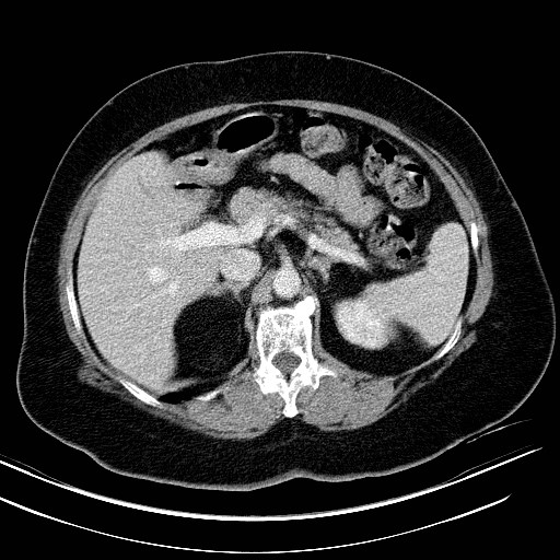 File:Adrenal myelolipoma (Radiopaedia 25413-25655 Axial C+ portal venous phase 1).jpg