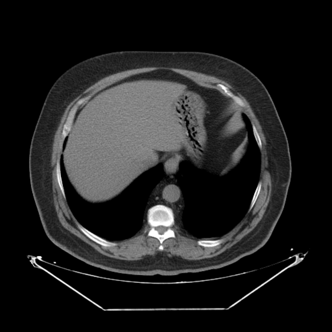 Adrenal myelolipoma (Radiopaedia 26278-26407 Axial non-contrast 6).jpg