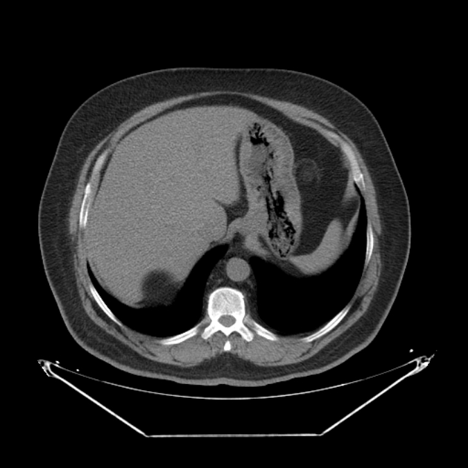 Adrenal myelolipoma (Radiopaedia 26278-26407 Axial non-contrast 9).jpg