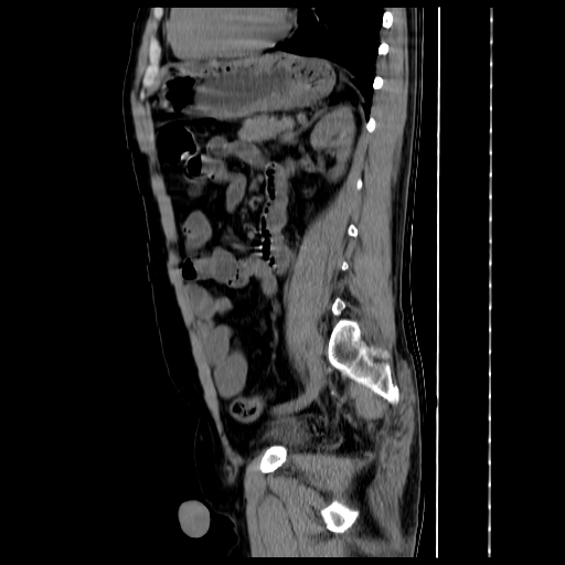 File:Adrenal myelolipoma (Radiopaedia 41843-44834 Sagittal non-contrast 26).jpg