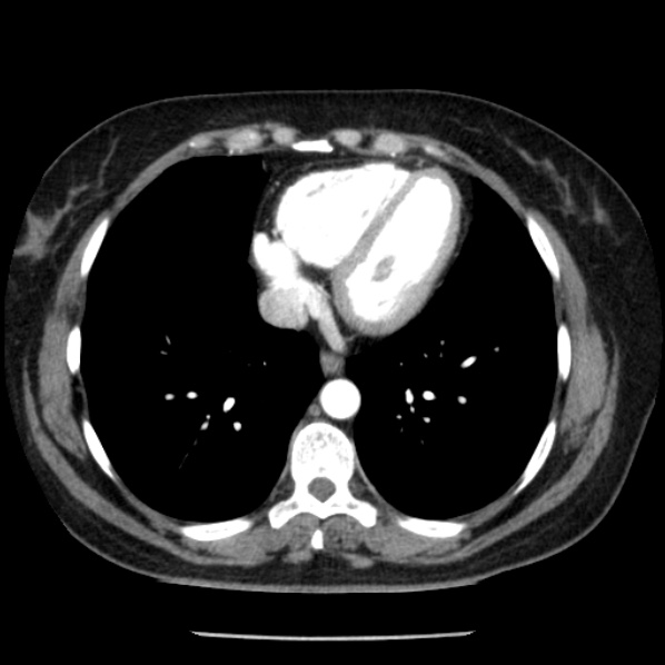 Adrenal myelolipoma (Radiopaedia 43401-46759 Axial C+ arterial phase 2).jpg