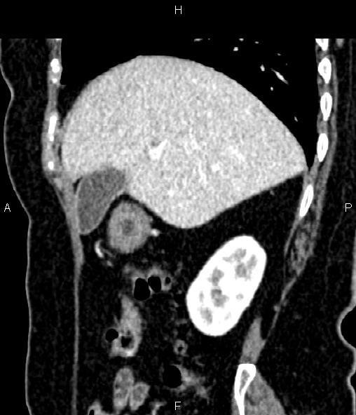 File:Adrenal myelolipoma (Radiopaedia 82742-96986 Sagittal renal cortical phase 33).jpg