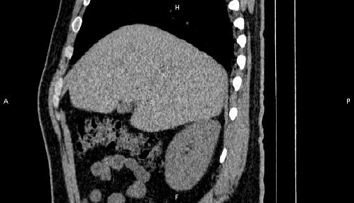 Adrenal myelolipoma (Radiopaedia 84321-99619 Sagittal non-contrast 27).jpg