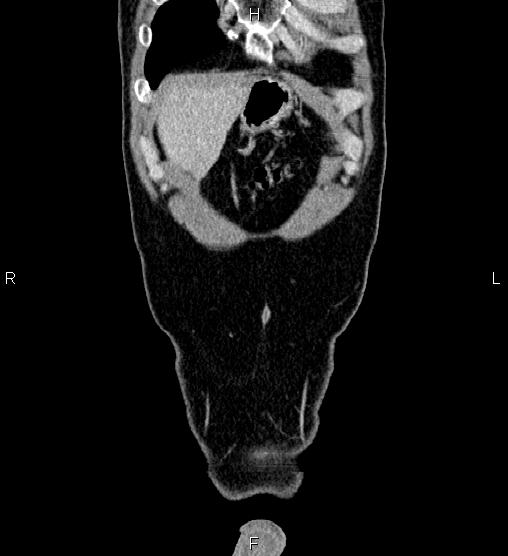 Adrenal myelolipoma (Radiopaedia 87794-104246 Coronal renal cortical phase 4).jpg