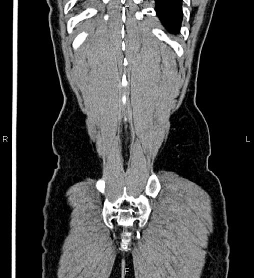 Adrenal myelolipoma (Radiopaedia 87794-104246 Coronal renal cortical phase 63).jpg