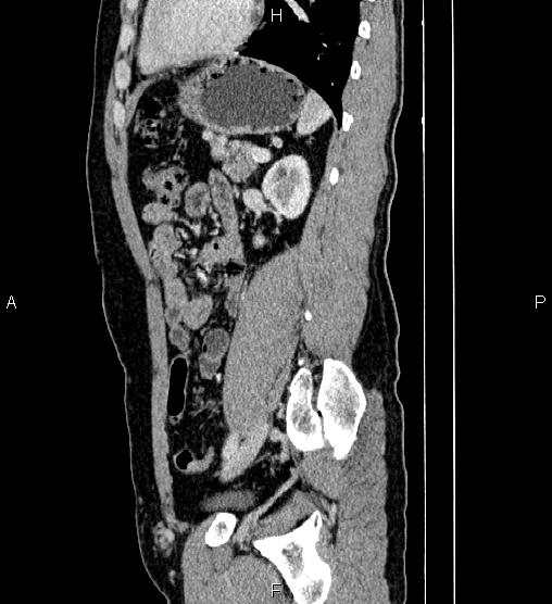 Adrenal myelolipoma (Radiopaedia 87794-104246 Sagittal renal cortical phase 64).jpg