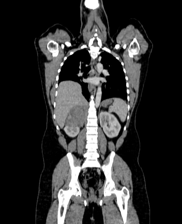 Adrenocortical carcinoma (Radiopaedia 80134-93438 Coronal C+ portal venous phase 109).jpg