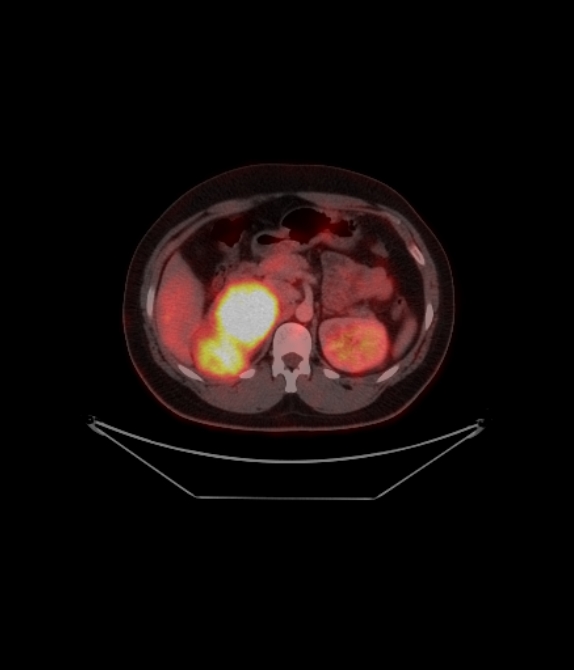 Adrenocortical carcinoma (Radiopaedia 80134-93440 ِAxial 168).jpg