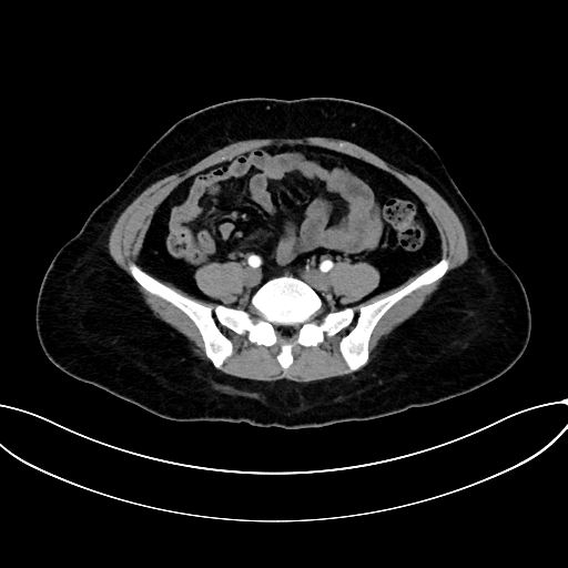 Adrenocortical carcinoma (Radiopaedia 87281-103569 Axial C+ arterial phase 61).jpg