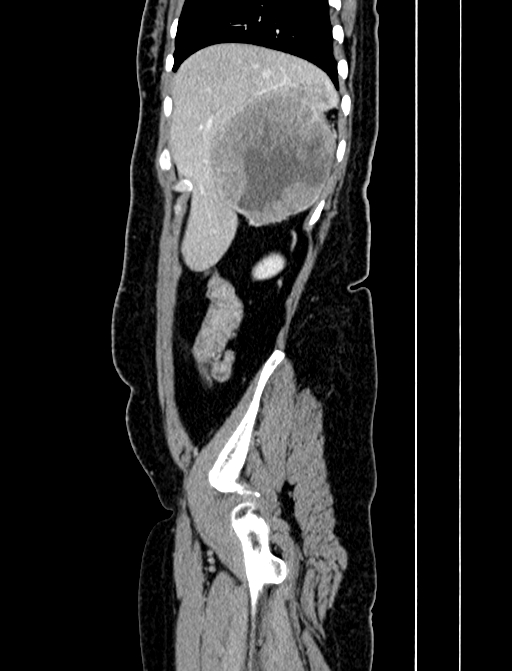 Adrenocortical carcinoma (Radiopaedia 87281-103569 Sagittal C+ portal venous phase 40).jpg