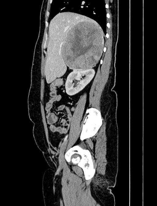 Adrenocortical carcinoma (Radiopaedia 87281-103569 Sagittal C+ portal venous phase 81).jpg