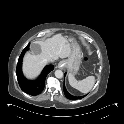 Adult ileal intussusception with secondary obstruction (Radiopaedia 30395-31051 Axial C+ portal venous phase 10).jpg