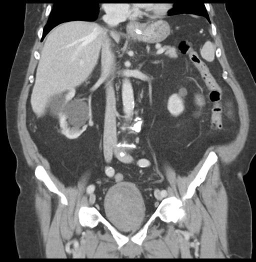 Adult ileal intussusception with secondary obstruction (Radiopaedia 30395-31051 Coronal C+ portal venous phase 33).jpg