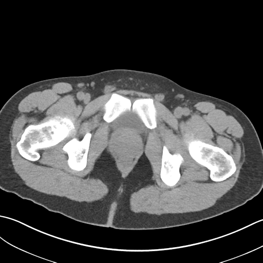 File:Adult polycystic kidney disease (Radiopaedia 47866-52626 Axial non-contrast 86).png