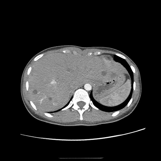 Adult polycystic kidney disease (Radiopaedia 48845-53876 Axial renal cortical phase 2).jpg