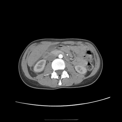 Adult polycystic kidney disease (Radiopaedia 48845-53876 Axial renal cortical phase 31).jpg