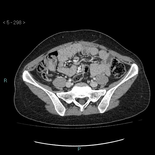 Adult transient intestinal intussusception (Radiopaedia 34853-36310 Axial C+ portal venous phase 69).jpg