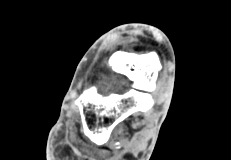 Advanced osteomyelitis due to open metatarsal fracture (Radiopaedia 83891-99095 Axial non-contrast 11).jpg