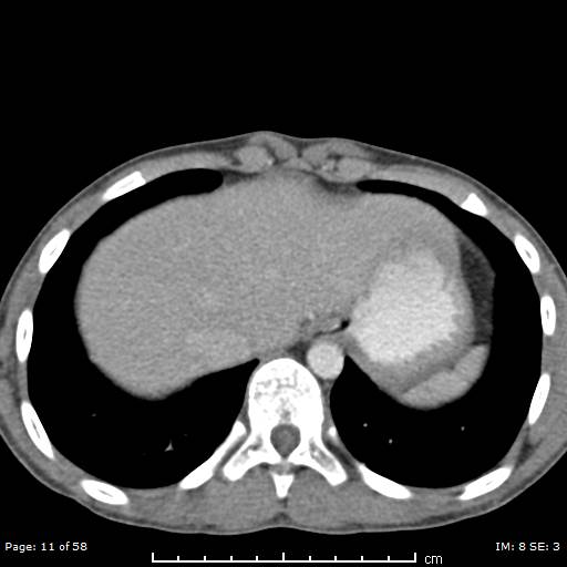 File:Agenesis of the gallbladder (Radiopaedia 55454-61905 B 11).jpg