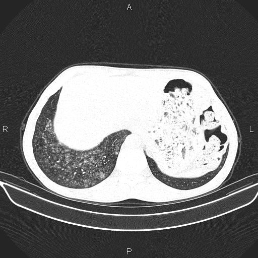 Air bronchogram in pneumonia (Radiopaedia 85719-101512 Axial lung window 60).jpg