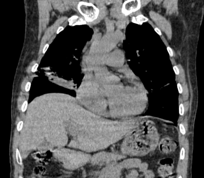 Airway foreign body in adult (Radiopaedia 85907-101779 Coronal liver window 97).jpg