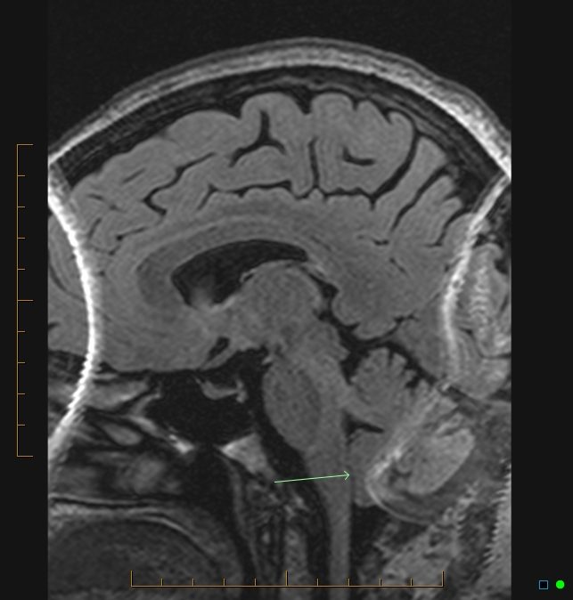 Aliasing artifact causing a spurious cerebellar lesion (Radiopaedia 48783-53810 Sagittal FLAIR 53).jpg