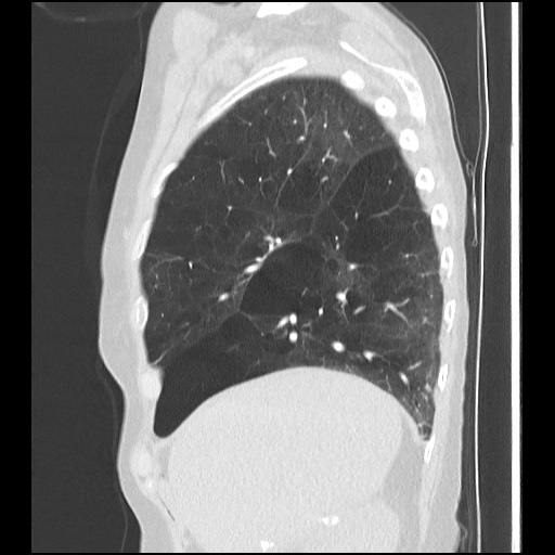 File:Alpha-1-antitrypsin deficiency (Radiopaedia 64893-73840 Sagittal lung window 13).jpg
