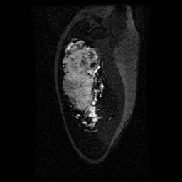 Alveolar soft part sarcoma (Radiopaedia 64501-73678 D 112).jpg