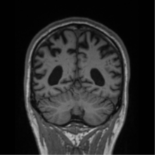 File:Alzheimer's disease- with Gerstmann syndrome and dressing apraxia (Radiopaedia 54882-61150 Coronal T1 25).png