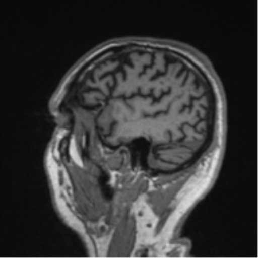 Alzheimer's disease- with Gerstmann syndrome and dressing apraxia (Radiopaedia 54882-61150 Sagittal T1 59).png