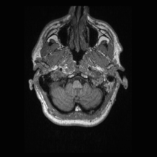 File:Alzheimer disease - probable (Radiopaedia 35334-36837 Axial T1 13).png
