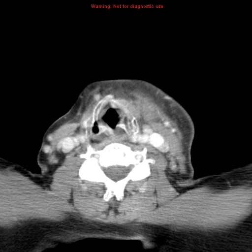 Ameloblastoma (Radiopaedia 27437-27631 A 64).jpg